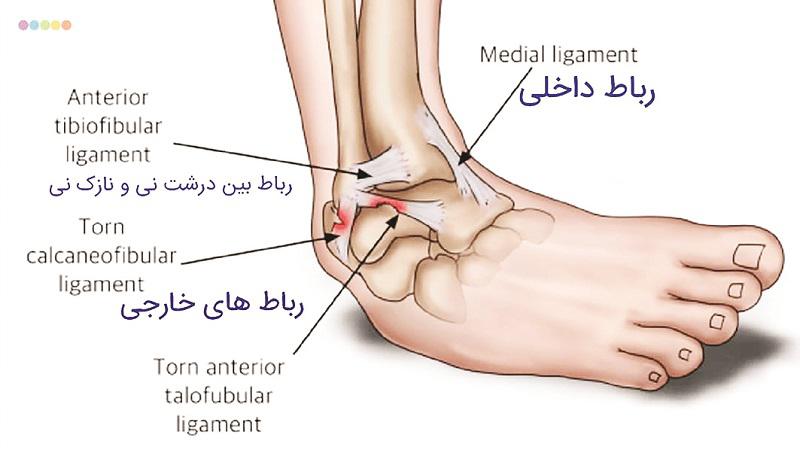 آسیبهای ورزشی| صدمات ناشایع، اما مهم در پیچخوردگی مچ پا - 8