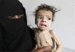 جان باختن ۸۵ هزار کودک در یمن به دلیل سوء تغذیه